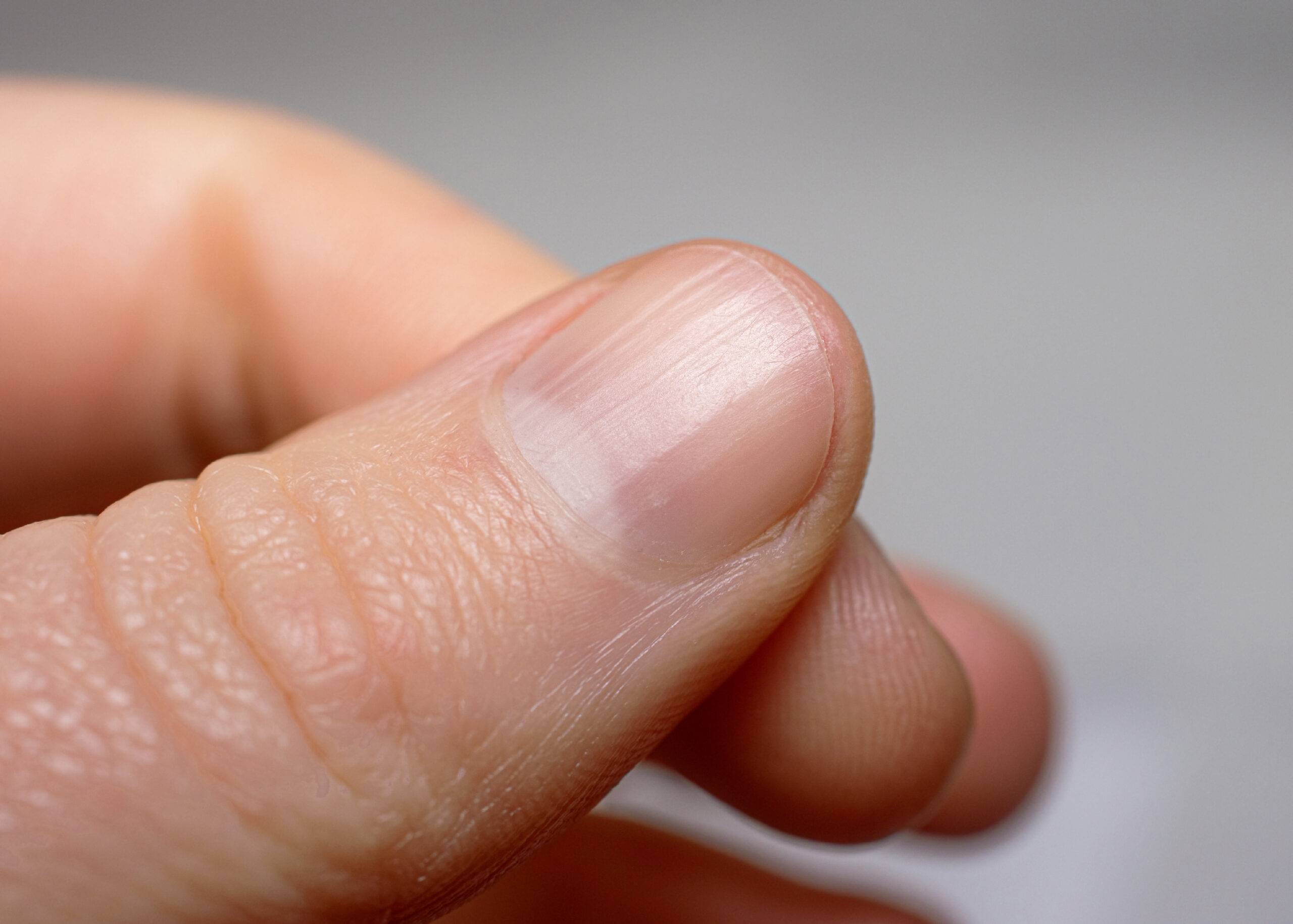 What Those Vertical Ridges On Your Nails Say About Your Health